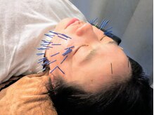 カンワ美容鍼灸院(KANWA美容鍼灸院)/気になる目のキワにも