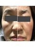 【目元・口元・眉間小じわ】エクソソーム導入付ハーブピーリングで若々しく！