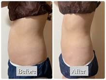 オレンジ(Orange)/1部位/痩身マシンBefore After