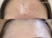 ミーラヤ(MILAYA)/梅田毛穴/梅田リアボーテ