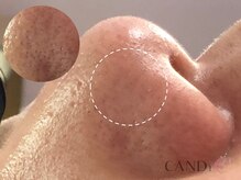 キャンディ 天王寺(CANDi)/ハイドラピーリング黒ずみ毛穴◎