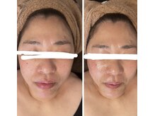 マオ(mao)/☆1回Before→after☆