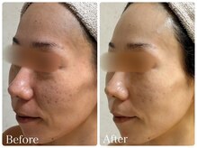 ロイヤル(ROYAL)/毛穴/赤み/ごわつき改善症例