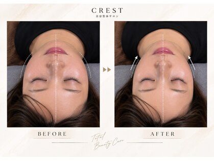 クレスト(CREST)の写真