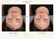 クレスト(CREST)