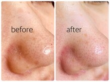 シェミー(CHEZ MEE)/【即実感】毛穴洗浄・イオン導入