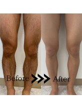 アールブイ 館林店(RV)/足脱毛