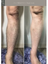 ハイリンク(High Link)/《両脚》before→after