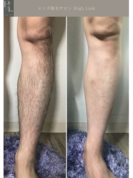 ハイリンク(High Link)/《両脚》before→after