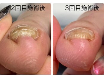 ロンディネ(Rondine)/巻き爪&トラブルネイルケア17