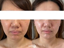 シェリー(cherie)/タルミ、ほうれい線ストップ