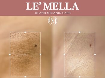 セレーノ 白金台(seReno)の写真/最先端＊韓国で注目の黒ずみケア【LE`MELLE/ルメラ】新導入!着色料不使用で肌本来の自然なピンク色に。
