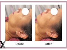 クロス(Xcross)/ニードレスインジェクター/渋谷