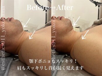 エステティックス ナインワンワン 横浜(Esthetics911) /首が長く！むくみスッキリ美肌