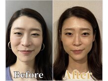 整体ラルース 中目黒(LALUZ)/30代 女性 頭蓋骨小顔矯正　変化