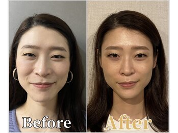 整体ラルース 中目黒(LALUZ)/30代 女性 頭蓋骨小顔矯正 変化