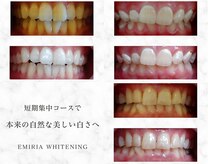 エミリアホワイトニング(EMIRIA WHITENING)