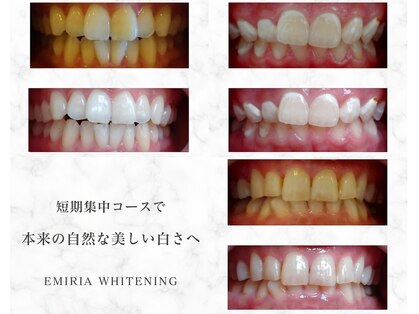 エミリアホワイトニング(EMIRIA WHITENING)の写真