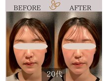 チョコバリ 新宿店(chocobari)/小顔×リフトアップ(美容鍼)20代