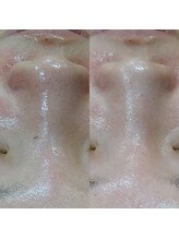 ボーソリューション(Beau-Solution)/【20代 ざらつき 黒ずみ毛穴】