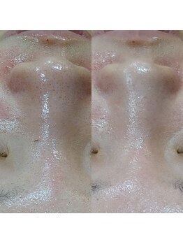 ボーソリューション(Beau-Solution)/【20代 ざらつき 黒ずみ毛穴】