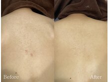 TD 鵜沼店/ハーブピーリング