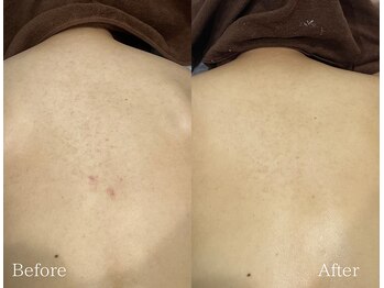 TD 鵜沼店/ハーブピーリング