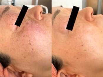 ルノア 小田原(Lunoa)の写真/【乳酸ピーリング】で肌悩みを改善