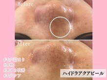 エンクリニカルラボ 三宮店(E&N CLINICAL LABO)/毛穴洗浄☆ハイドラアクアピール