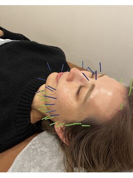 ビープラス(BEE PLUS)の写真/《結果重視！美容鍼》¥4,000から☆内側から輝く肌◎小顔・美肌・肌質改善・ニキビケア★美容鍼でつるん肌!