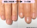 自爪育成