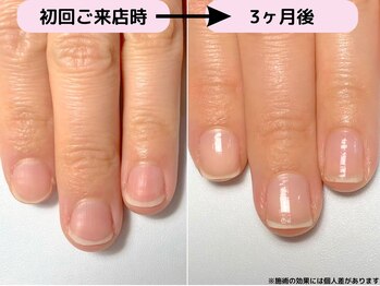 カピリナ(Ka Pilina)/自爪育成