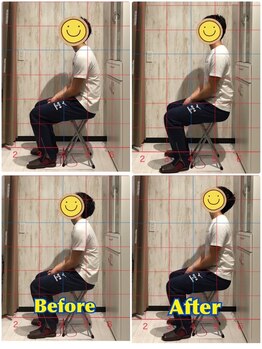 くすの樹接骨院 整体院 鳥栖院/整体/骨盤矯正ビフォーアフター