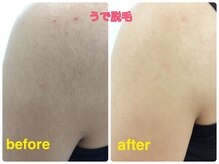 ラウレア 松山店(LAULEA)/腕脱毛　before/after