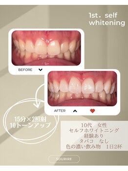 スリール(sourire)/ビフォーアフター