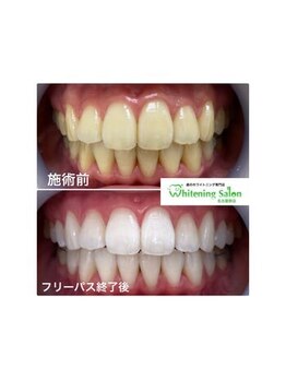 ホワイトニングサロン 名古屋駅店/【ホワイトニング施術例】