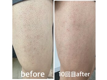 セルフ脱毛サロン SELFMADE イオンタウン仙台泉大沢店【3/29 NEW OPEN(予定)】 /【ビフォーアフター】セルフ脱毛