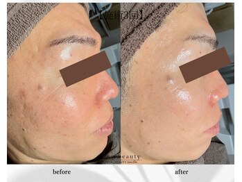 アン ビューティー(ann beauty)/施術3回【症例写真】30代