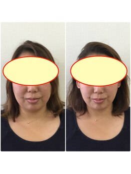 やち鍼灸院/印象アップ！人気の小顔整体！