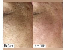 フェミニー(Feminy)/シミケア／どんどん薄く