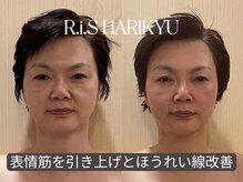 リス(R.i.S)/小顔矯正Before&After
