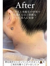 エリス(ELISSE)/ワックスと光脱毛のダブル効果