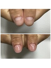 エルナ(elna)/即日で見た目改善