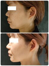 ラナ(LANA)/レモンボトル☆BeforeAfter