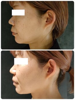 ラナ(LANA)/レモンボトル☆BeforeAfter