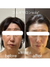 ソラ(sola*)/キュッとリフトアップ