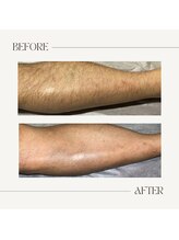 カラット(CARAT)/メンズ脚脱毛