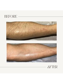 カラット(CARAT)/メンズ脚脱毛