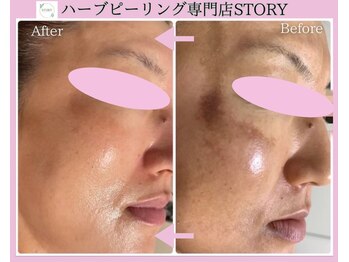 ストーリー(STORY)/ハーブピーリング専門店STORY