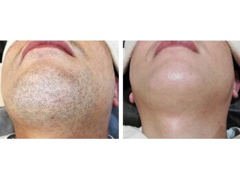 セブンボーテ(7Beaut'e)/ひげ脱毛♪